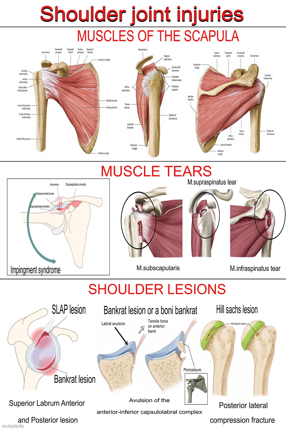 Poster showing shoulder joint injuries including rotator cuff tears and labral lesions