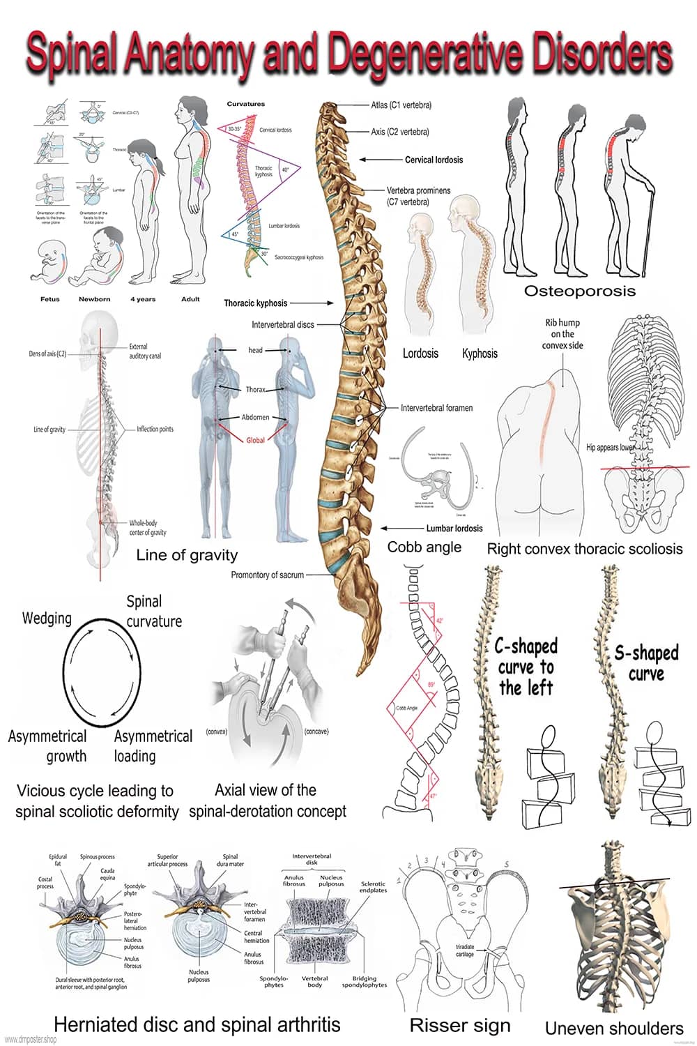 Spinal Anatomy And Degenerative Disorders anatomical poster main view
