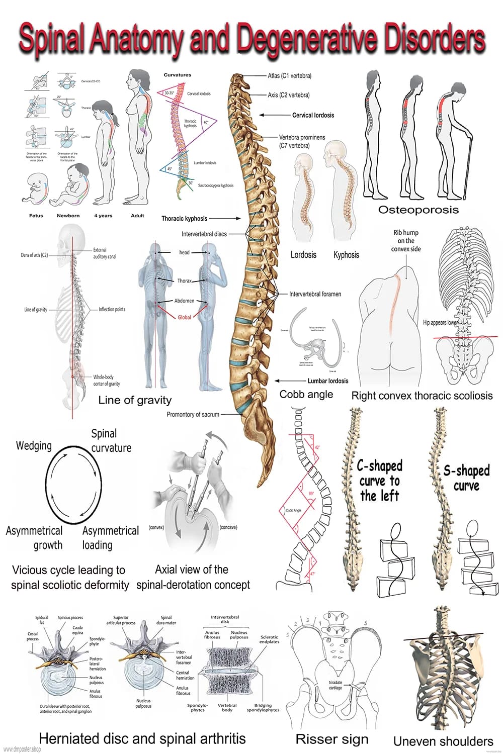 Spinal Anatomy And Degenerative Disorders anatomical poster main view
